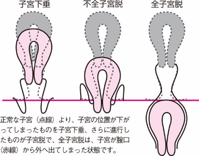 子宮脱 子宮下垂の治し方は 自力で押し込むのは大丈夫 タンポンは使えるの Casual